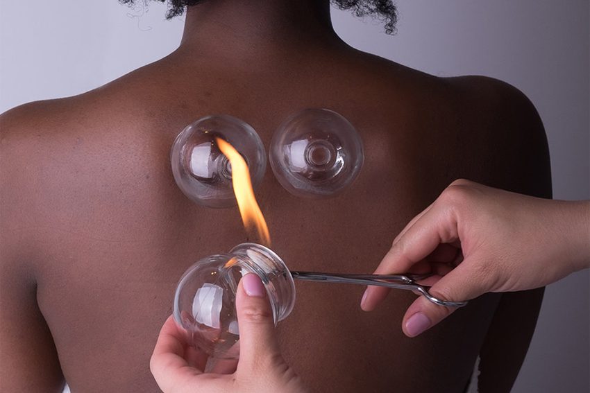 A person receiving cupping therapy on their back.